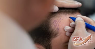 hair transplant in albania best clinics for 2024 cos