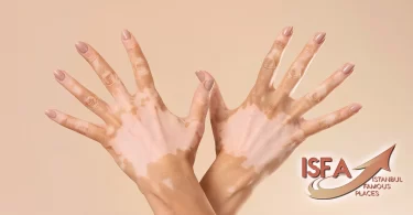 vitiligo Istanbul