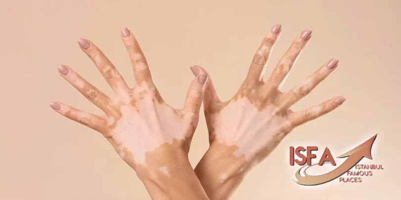 vitiligo Istanbul